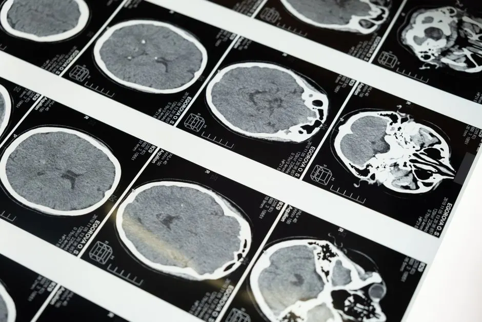 Stopper Alzheimer : une nouvelle approche prometteuse